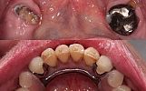 Missing lower teeth replaced with special attachment crowns and special attachment chrome cobalt den