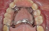 Missing upper teeth replaced with special attachment crowns and  chrome cobalt denture