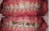 Fastbraces® Orthodontics