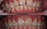 Fastbraces® Orthodontics