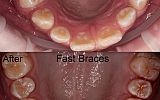 Fastbraces® Orthodontics