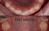 Fastbraces® Orthodontics