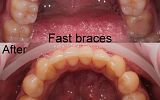 Fastbraces® Orthodontics