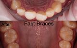 Fastbraces® Orthodontics