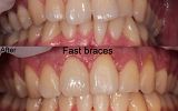 Fastbraces® Orthodontics
