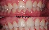 Fastbraces® Orthodontics