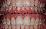 Fastbraces® Orthodontics