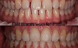 Fastbraces® Orthodontics