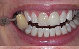3 sameday emax porcelain veneers and tooth whitening