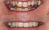 9 Emax Porcelain overlay crowns and veneers to subtly improve appearance