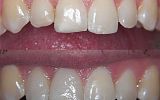 2 same-day emax porcelain veneers