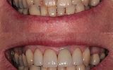 3 Emax porcelain veneers & crown