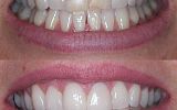 3 sameday emax porcelain veneers and tooth whitening