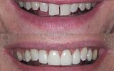 4 Emax Porcelain veneers to close gaps
