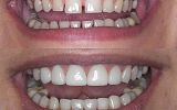 7 Emax Porcelain veneers to close gaps