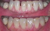2 same-day emax porcelain veneers to close gaps