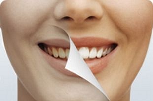 Tooth whitening