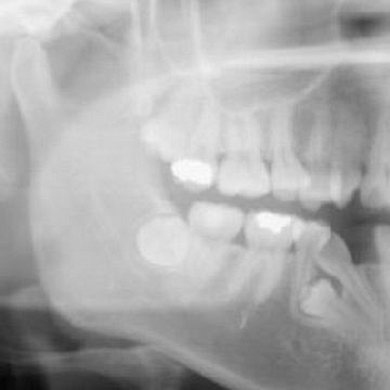 Digital X-rays