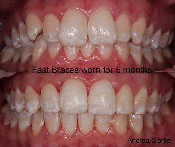 5 months start to finish - Andrea Clarke BDS 